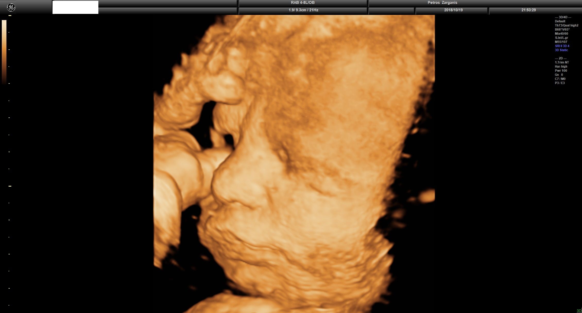 Εμβρυο 36 Εβδομάδων Προγεννητική Υπερηχογραφία 3D 13